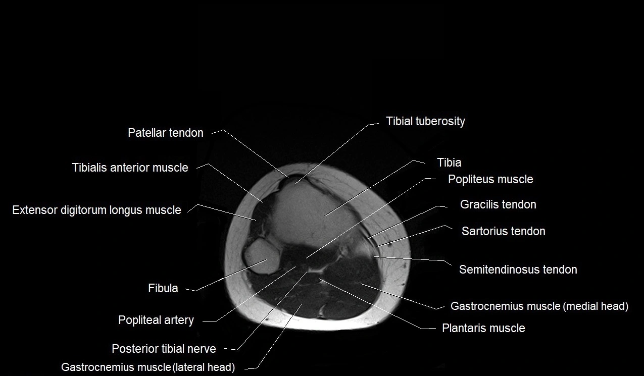 MRI thigh cross sectional anatomy image 63.webp